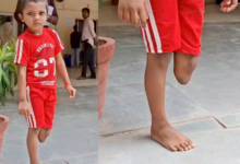 banda girls leg amputated